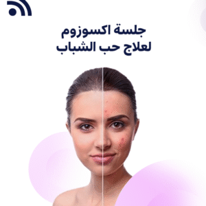 جلسة اكسوزوم لعلاج حب الشباب
