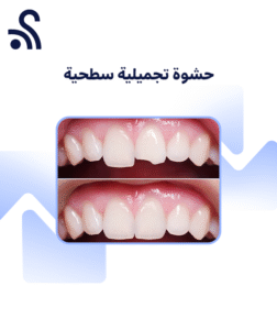 Superficial Cosmetic Filling