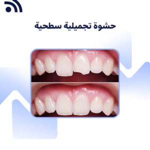 حشوة تجميلية سطحية
