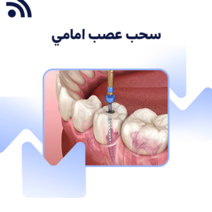 سحب عصب امامي