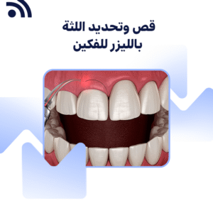 قص اللثة وتحديد اللثة بالليزر للفكين