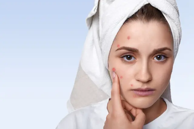 علاج حب الشباب وآثاره